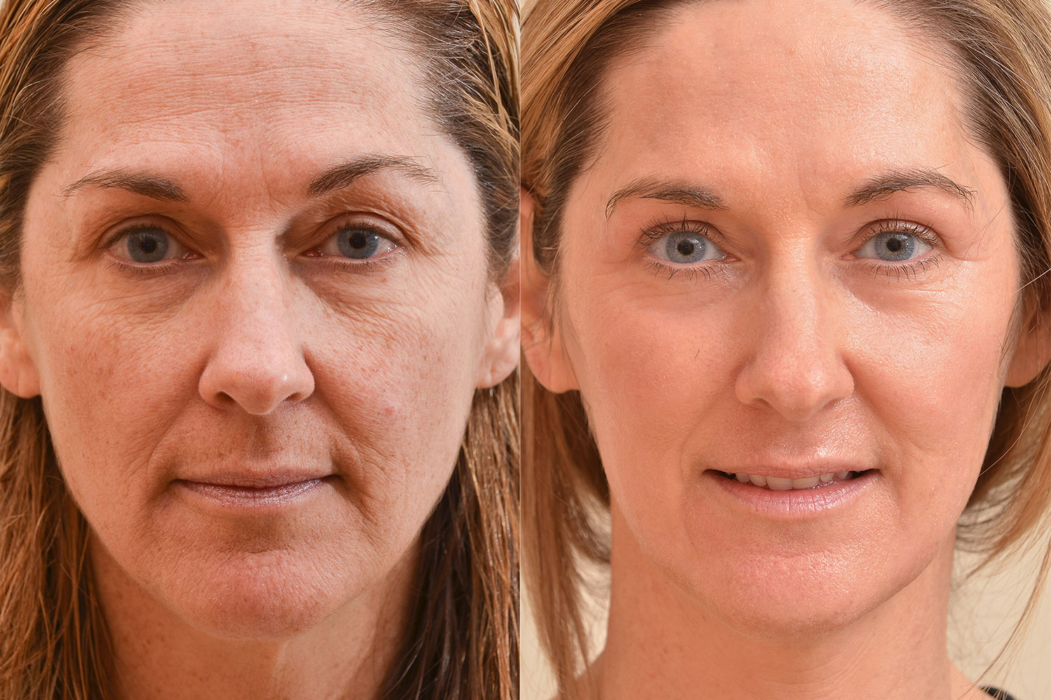 Resurfacing of the skin with lasers